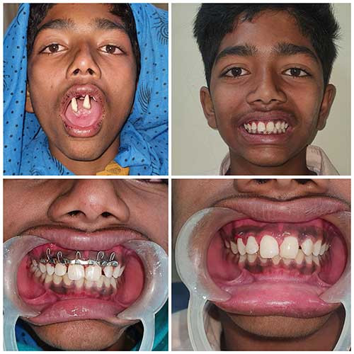 Permanent teeth restored in a 15 YO boy at Kasturba Hospital